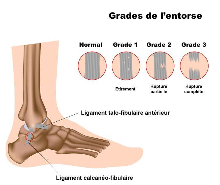 Grades entorse cheville