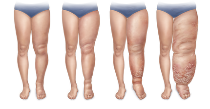 illu_med_stages-lymphedema-leg_sigvaris_group.png